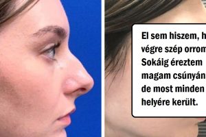 20 bátor ember, akik szépészeti beavatkozáson estek át, és soha nem voltak ilyen boldogok