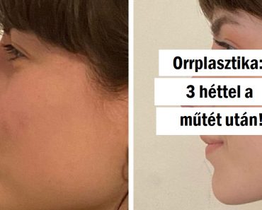 20+ nő, aki úgy gondolta, hogy átesik egy plasztikai műtéten és bebizonyítja, nincs határ, ha a maximalitásról beszélünk