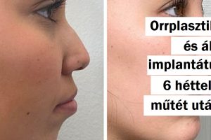 18 személy, aki úgy döntött, hogy plasztikai műtéten esik át, és az eredmény önmagáért beszél