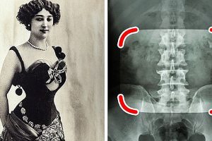 10 divattrend a régi időkből, ami bebizonyítja, hogy az emberek bármire képesek voltak a szépségért