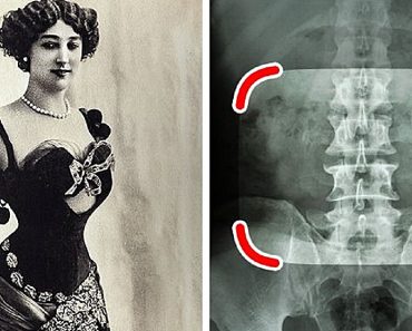 10 divattrend a régi időkből, ami bebizonyítja, hogy az emberek bármire képesek voltak a szépségért