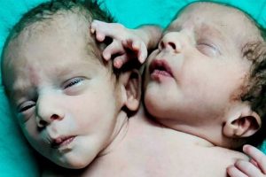 A baba két fejjel, három karral és két szívvel született: Az orvosok elképedtek, amikor a csecsemő az esélyek ellenére túlélte a születést Indiában