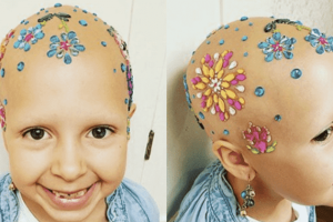Az alopeciás kislány megnyerte az „őrült hajnapot” az iskolában: „Most már imádok kopasz lenni