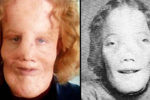 Rocky Dennis hihetetlen élete – a fiú, akinek ritka deformitása ihlette az 1985-ös „Maszk” című filmet.