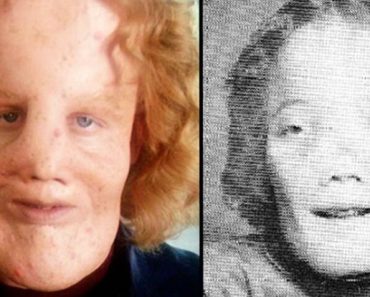 Rocky Dennis hihetetlen élete – a fiú, akinek ritka deformitása ihlette az 1985-ös „Maszk” című filmet.