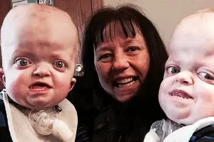 A nővér örökbe fogadta a ritka fogyatékossággal élő ikreket, miután a szülők nem tudtak gondoskodni róluk: „Beléjük szerettem”