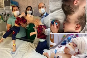Összenőtt agyú sziámi ikrek szétválasztva; a sebészek hónapokig gyakoroltak a virtuális valóságban