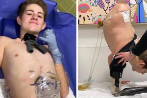 A targonca által összezúzott 19 éves fiatalember úgy döntött, hogy amputáltatja testének alsó felét, hogy megmentse az életét