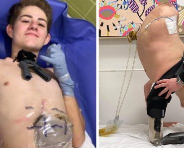 A targonca által összezúzott 19 éves fiatalember úgy döntött, hogy amputáltatja testének alsó felét, hogy megmentse az életét