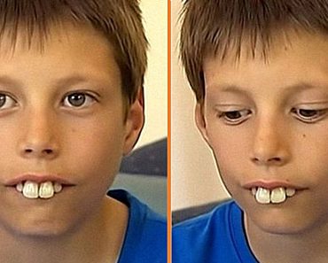 A fiú, akit a feltűnő foghibája miatt zaklattak, új mosolyt kapott az idegenek kedvességének köszönhetően