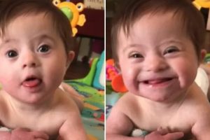 Az örökbefogadott Down-szindrómás kislány milliók szívét olvasztja el, miután megmutatta örökbefogadó anyukájának az „új mosolyát”