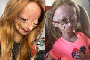 Adalia Rose Williams – A ritka korai öregedés szindrómában szenvedő lány: Íme az életének részletei