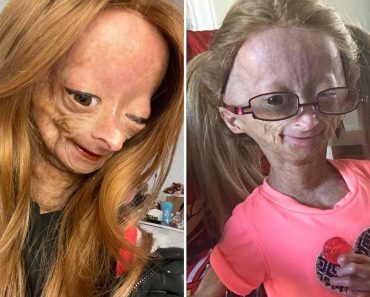 Adalia Rose Williams – A ritka korai öregedés szindrómában szenvedő lány: Íme az életének részletei