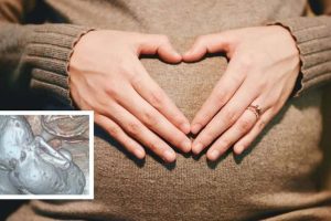 Mumifikálódott „kőbabát” találtak egy 73 éves idős nő hasában, akit 35 éven át hordott