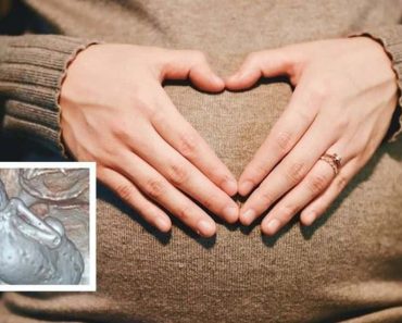 Mumifikálódott „kőbabát” találtak egy 73 éves idős nő hasában, akit 35 éven át hordott