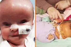 Az anya azt mondta, hogy „csoda” gyermeke úgy nézett ki, mint egy földönkívüli a születése után — A lány most „gyönyörűen” néz ki