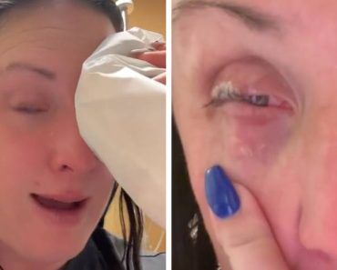 Az anyuka véletlenül beragasztotta a szemét, miután összetévesztette a körömragasztót a szemcseppel