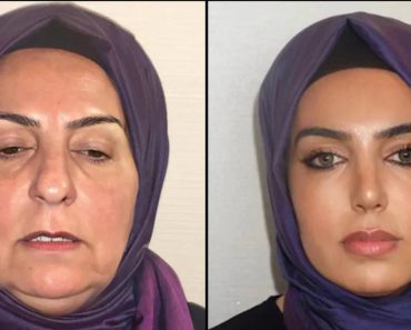 A török plasztikai sebészeti klinika előtte-utána képei hitetlenkedve hagyták az embereket