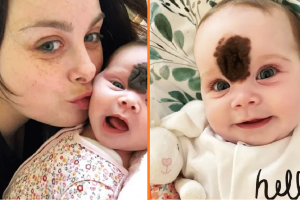 A szülők elrejtették a baba arcát, hogy megvédjék őt a bámulástól — most, 2 évesen, „gyönyörűen” néz ki a műtét után