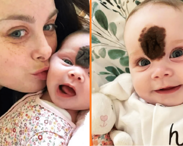 A szülők elrejtették a baba arcát, hogy megvédjék őt a bámulástól — most, 2 évesen, „gyönyörűen” néz ki a műtét után