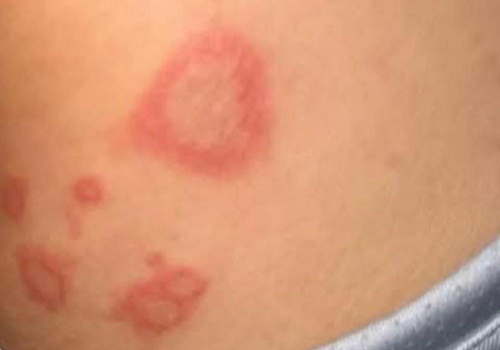 Mijn 15-jarige zoon bracht het weekend door bij zijn oma en kwam thuis met bultjes van verschillende groottes… Wat kan dit zijn?